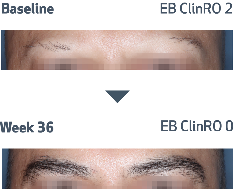 Eyebrow photos of alopecia areata patient at baseline and at week 36