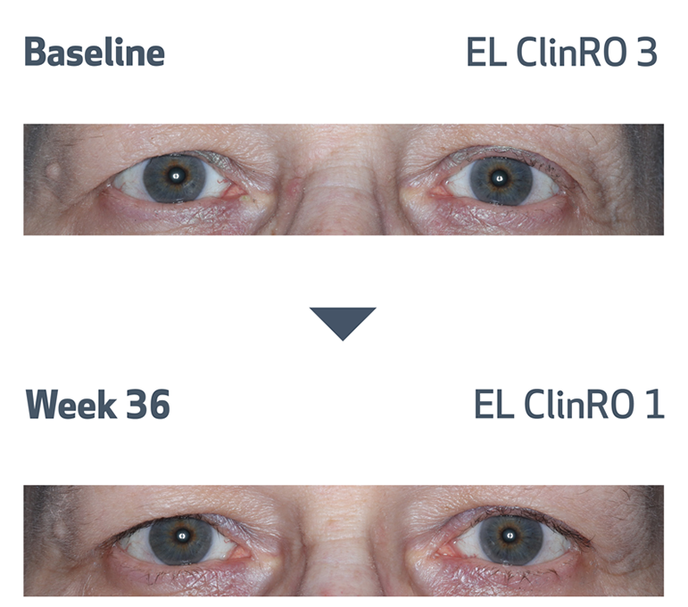 Eyelash photos of alopecia areata patient at baseline and at week 36