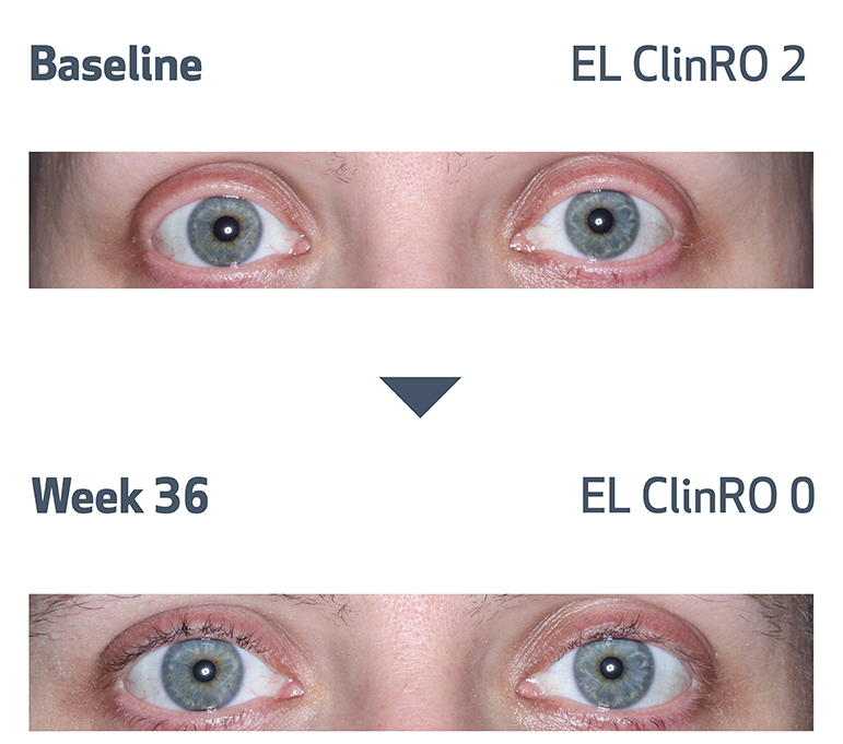 Eyelash photos of alopecia areata patient at baseline and at week 36
